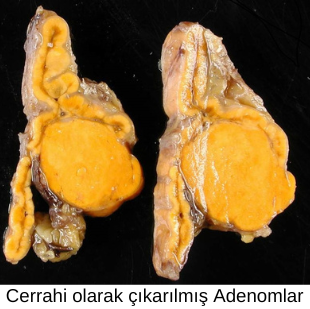 Adrenal adenom görseli - DrCem hastalık rehberi